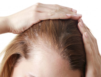 Treatment for female hair loss