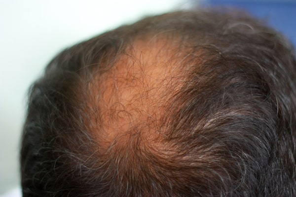 Learn more about the common causes for hair loss in patients