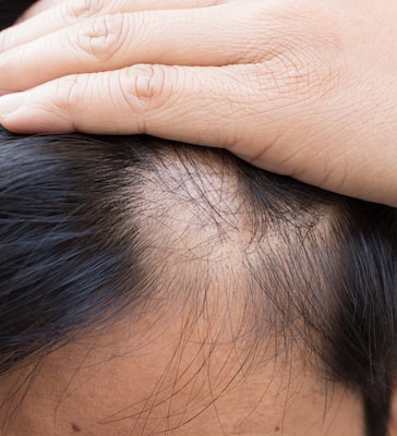 Different types of alopecia